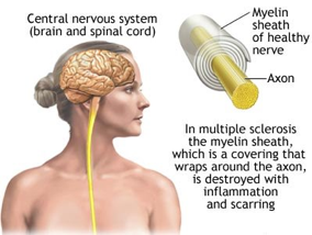 10 Things You Should Know About Multiple Sclerosis